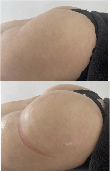 Non-surgical BBL before and after – side profile lift