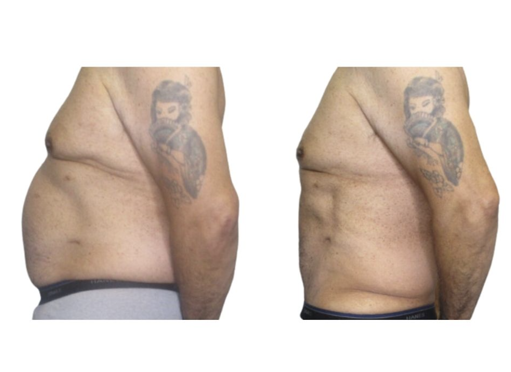 Before and after result 1