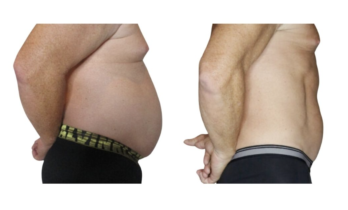Before and after result 5