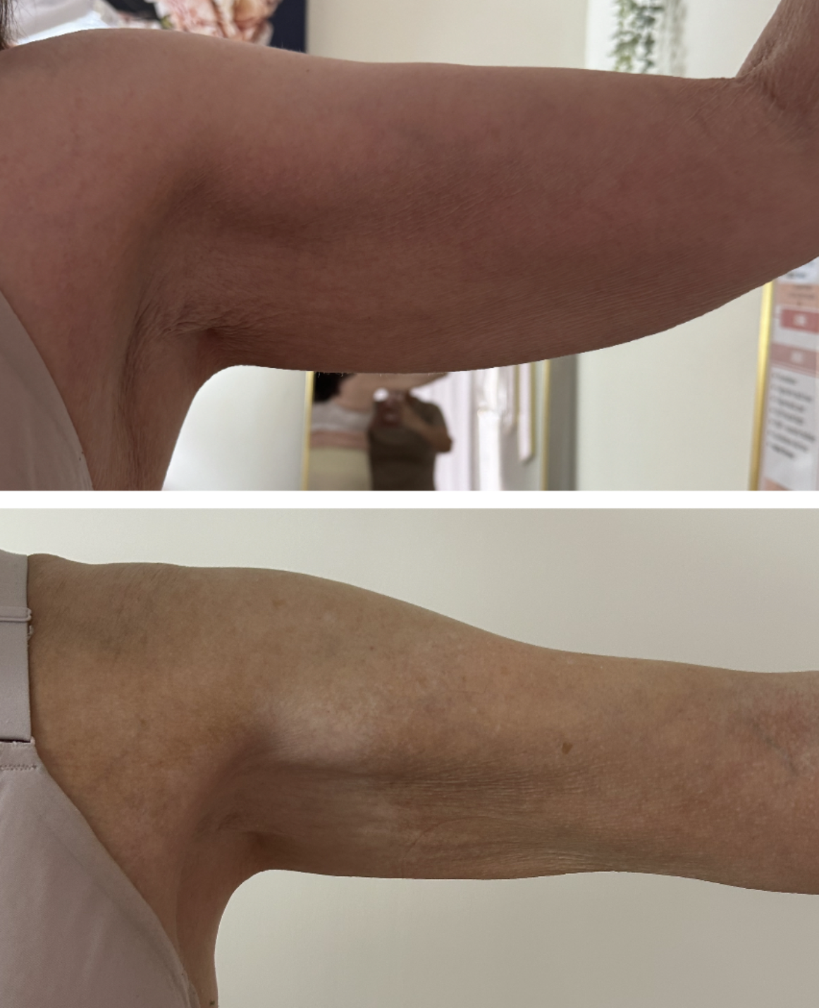 Body sculpting diamond package before and after — arm skin tightening