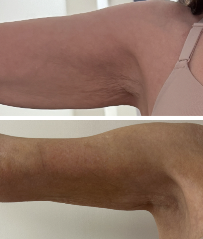 Body sculpting diamond package before and after — arm contouring and skin tightening