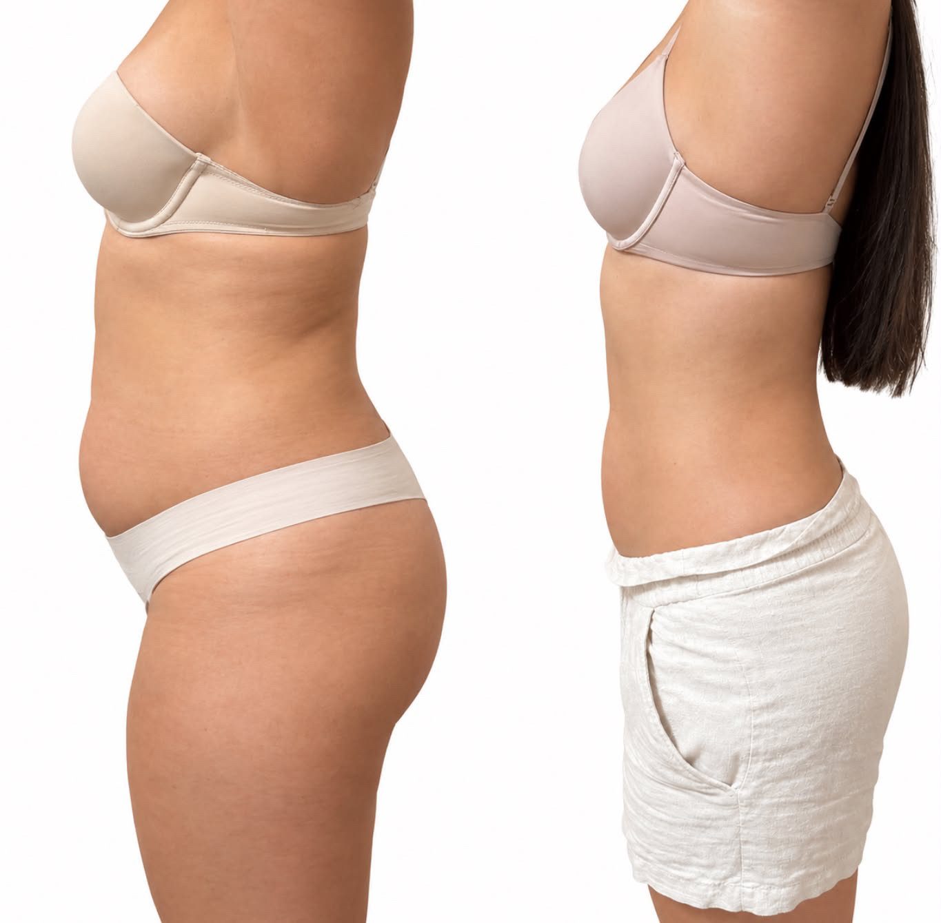 Body sculpting before and after result 1 — Jupiter & West Palm Beach