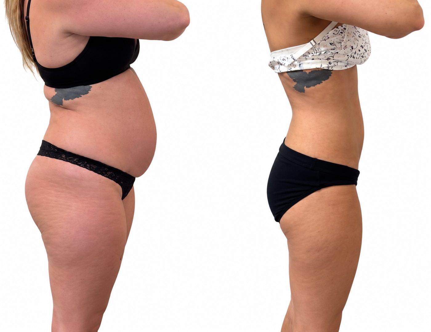 Body sculpting before and after result 2 — Jupiter & West Palm Beach