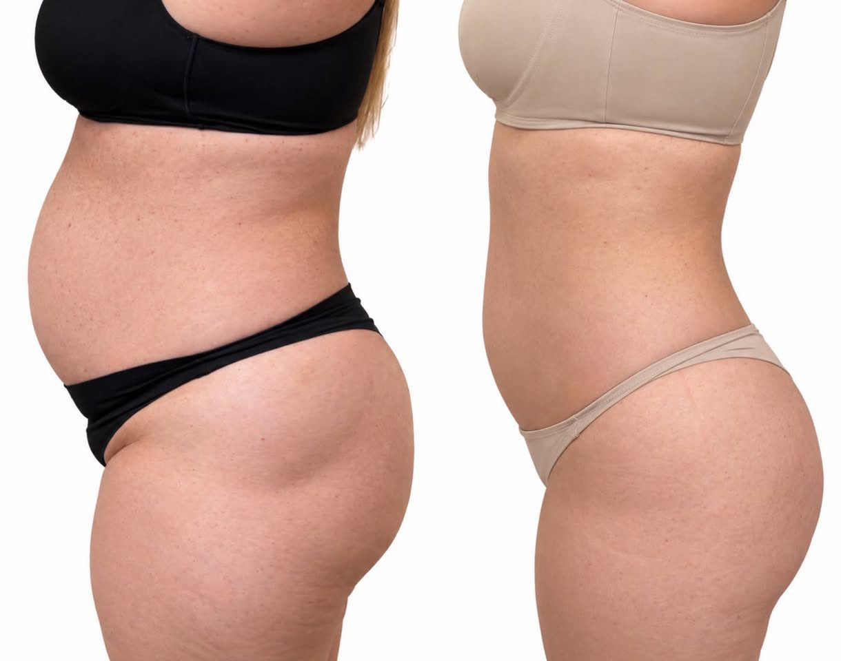 Body sculpting before and after result 4 — Jupiter & West Palm Beach
