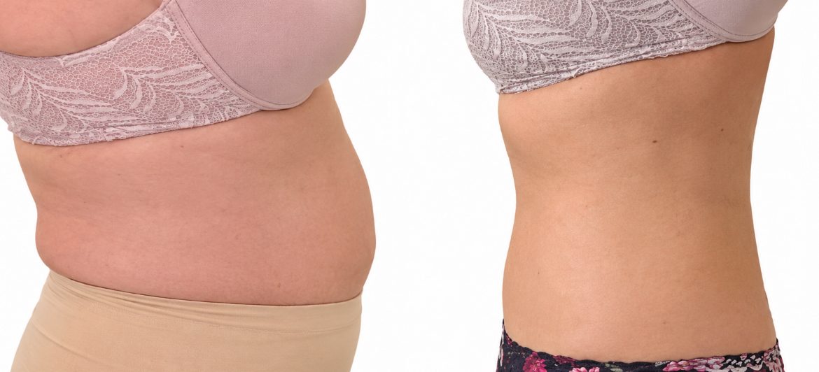 Body sculpting before and after result 6 — Jupiter & West Palm Beach
