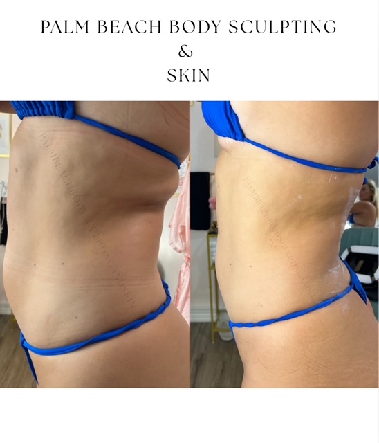 Brazilian Sculpt & Glow | Jupiter & West Palm Beach, FL