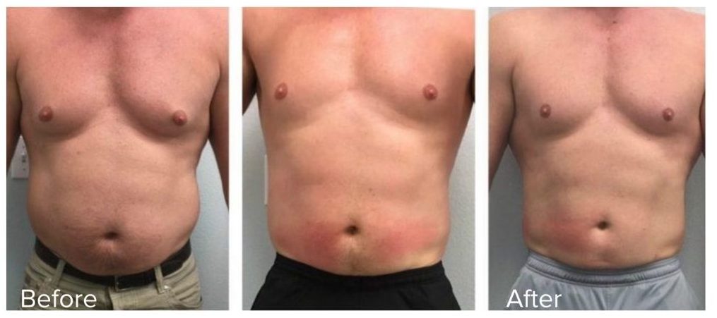 EMS muscle building before and after – male abdomen transformation