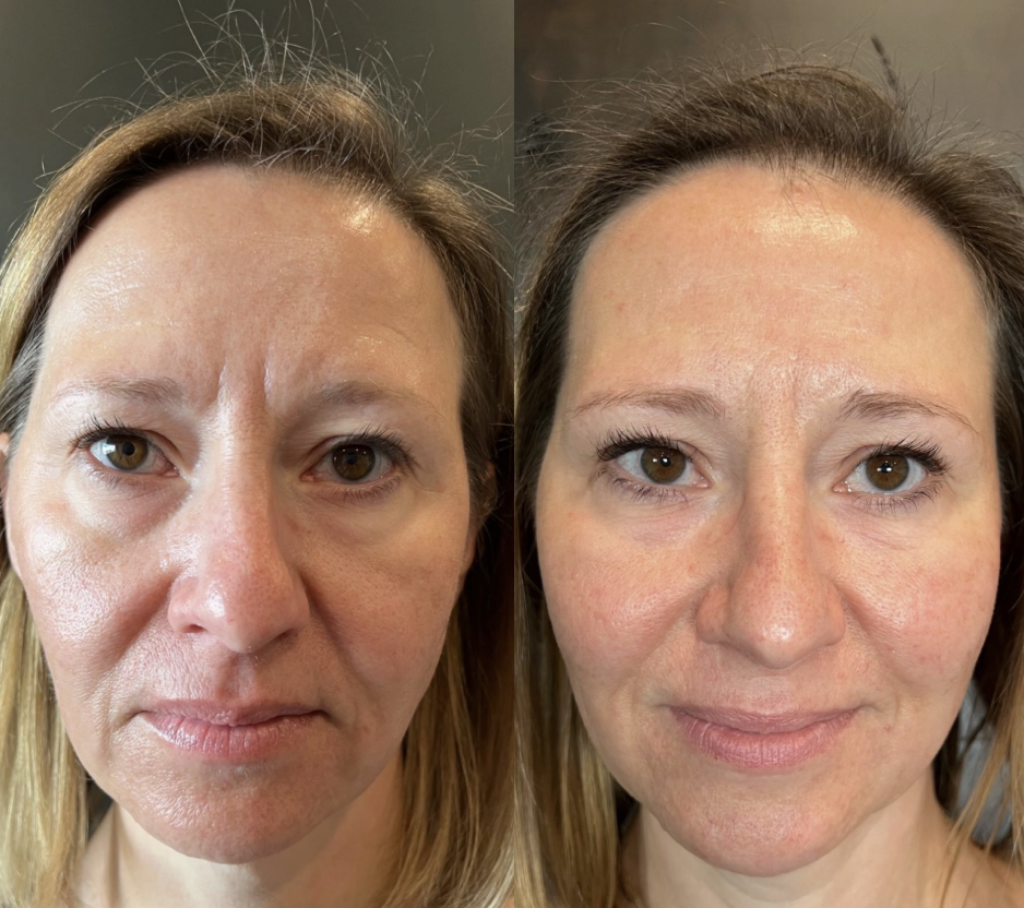 Skin Rejuvenation & Facials in Jupiter & West Palm Beach, FL