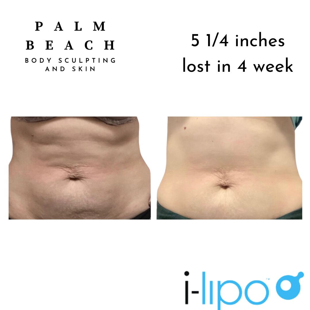 Before and after result 3