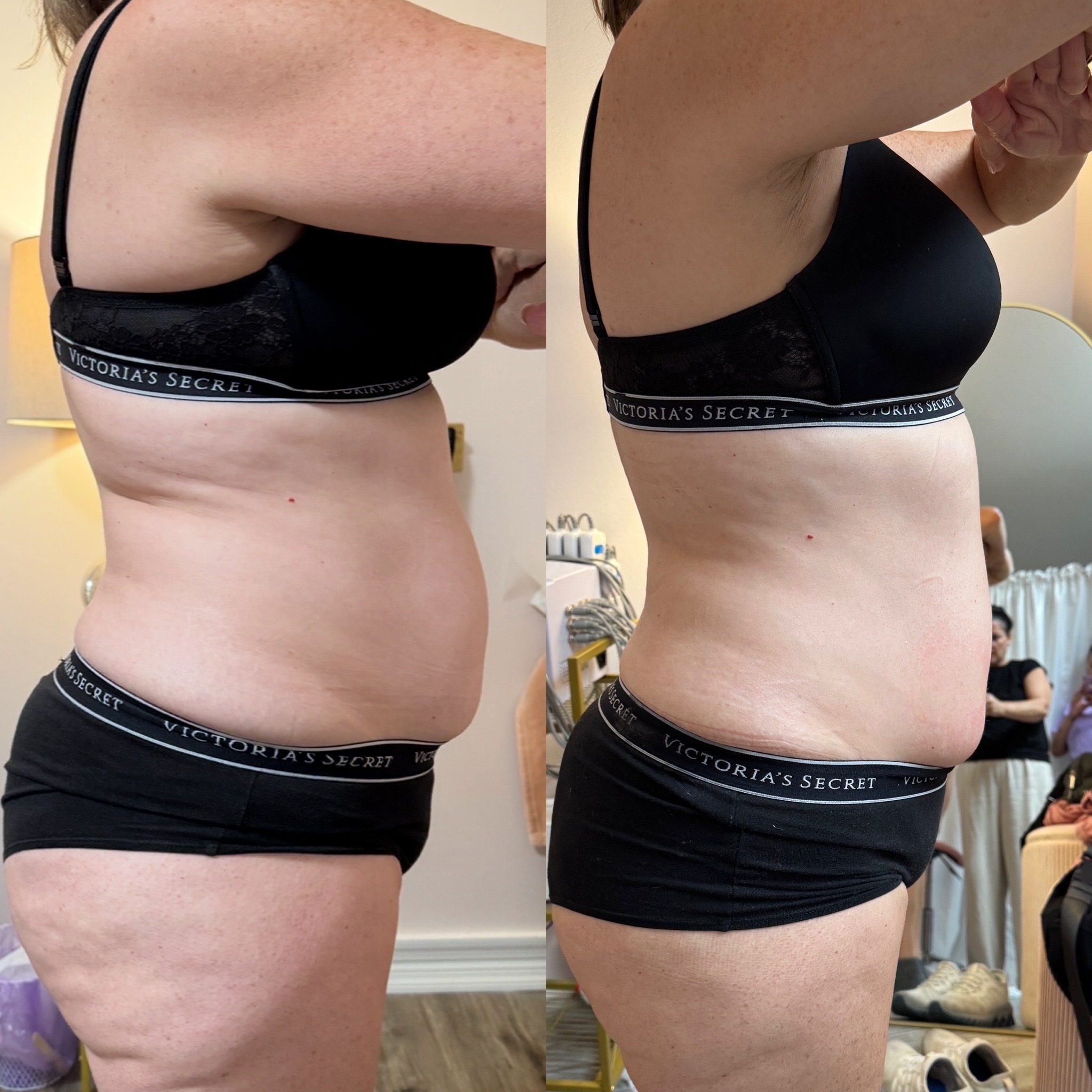 I-Lipo Laser Fat Reduction
