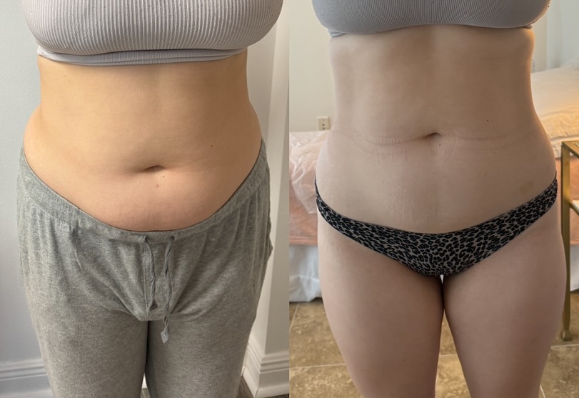 I-Lipo before and after result