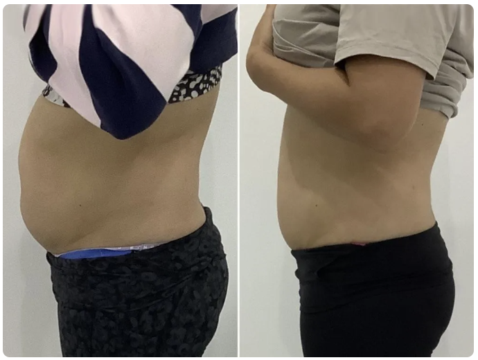 Mini Mommy Makeover before and after – female abdomen side view