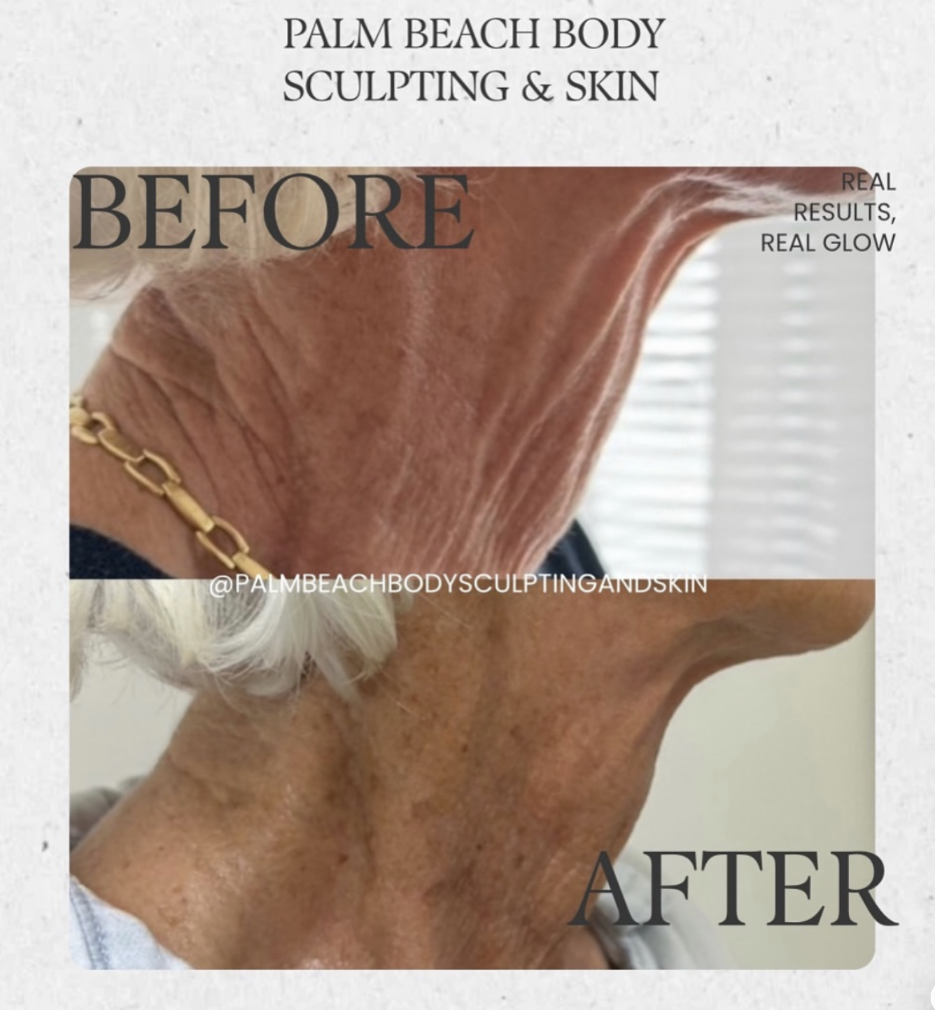 Non-invasive facelift before and after — neck and décolleté skin tightening