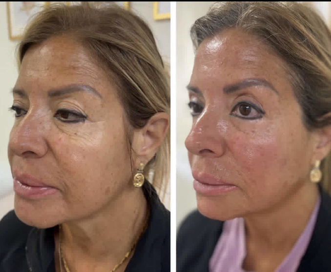 Non-invasive facelift before and after — facial contouring and skin rejuvenation