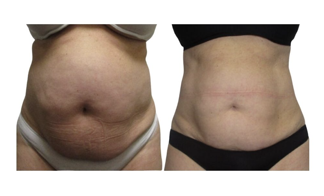 Weight loss and inch loss results at Palm Beach Body Sculpting & Skin